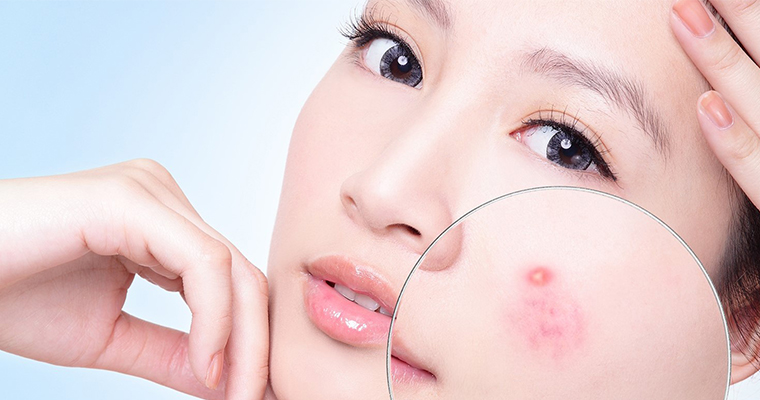 Kem trị mụn Kem trị mụn
